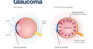 cbd contro il glaucoma